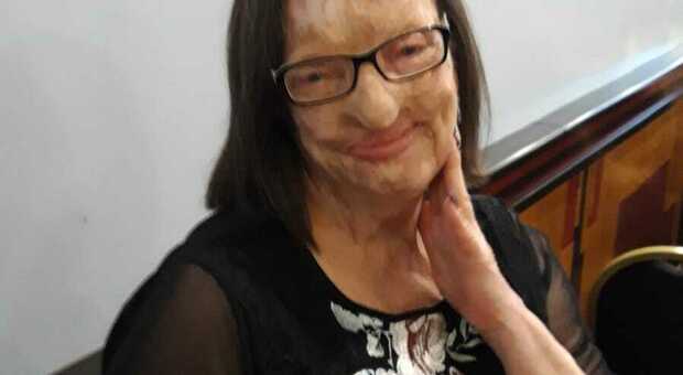 Filomena Lamberti, 64 anni, prima donna sfigurata dall'acido dal marito