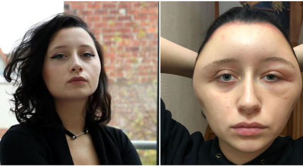 Diciannovenne sfigurata dopo la tintura per capelli: «Ho rischiato di morire»