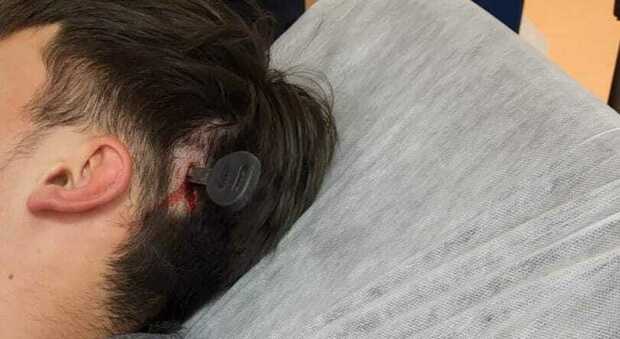 Napoli: chiave conficcata in testa, il 12enne colpito dopo una lite sul campo di calcetto