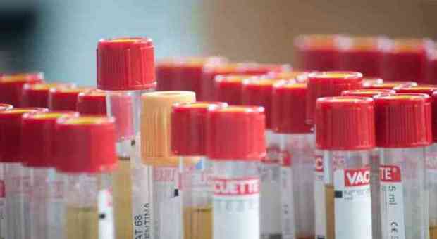 Tumore alle ovaie, un semplice test delle urine potrebbe dare una diagnosi precoce