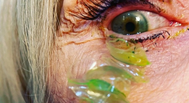 Una paziente ha dolore agli occhi: l'oculista le rimuove 23 lenti a contatto