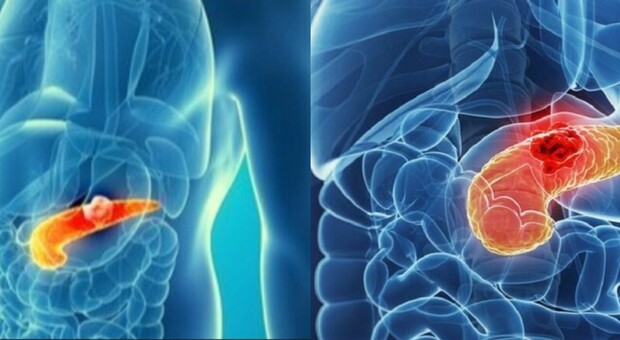 Tumore al pancreas, scoperto da uno studio italiano «un loop infiammatorio che alimenta la malattia»: le prospettive per nuove cure
