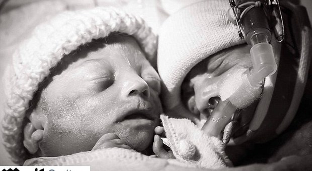 Il gemellino muore pochi giorni dopo la nascita, l'addio commuove il web