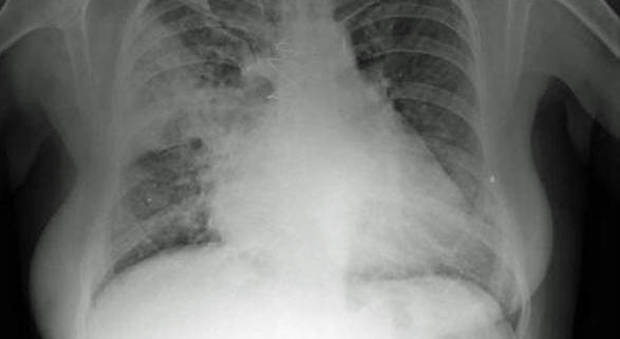 Allarme polmonite, 71 persone ricoverate al Pronto Soccorso