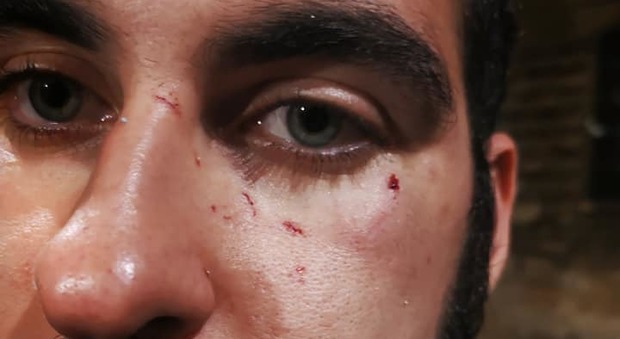 Fidanzati gay picchiati e insultati in strada: «Mi hanno spaccato gli occhiali sul viso»