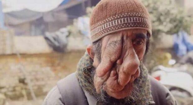 Tumore al viso lo rende irriconoscibile, 60enne nepalese operato grazie a una turista che organizza una raccolta fondi