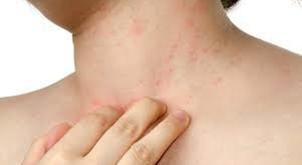 Dermatite atopica, sabato 8 giugno visite gratuite al Policlinico Tor Vergata