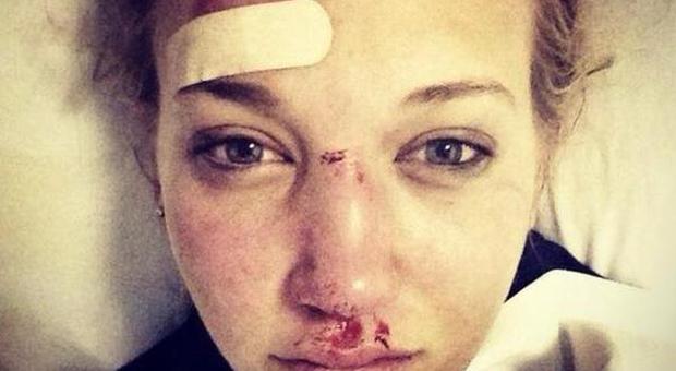 Rowan Cheshire, la 18enne sciatrice mostra le cicatrici della sua caduta a Sochi (Twitter/LaPresse)