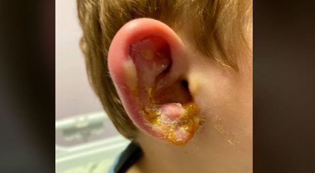 Bimbo di 4 anni contrae l'herpes dopo un bacio: «Ogni volta sta malissimo, lo avrà per tutta la vita»