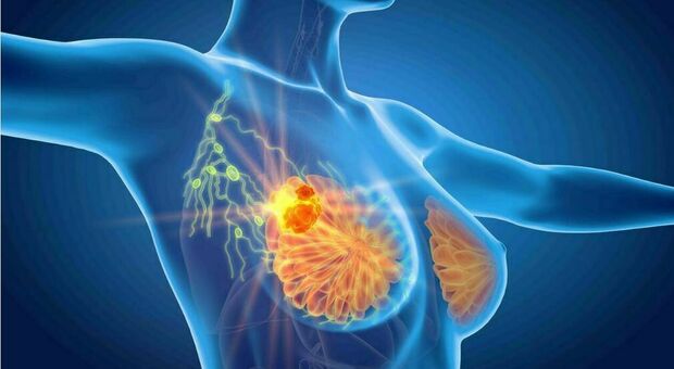Tumore seno, cura riduce del 25% il rischio recidive: ruolo chiave della molecola ribociclib