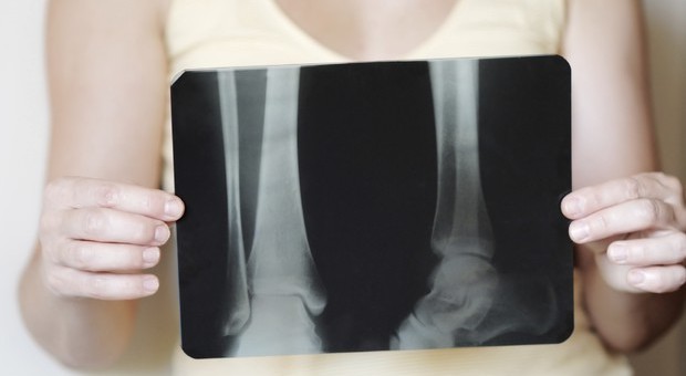 Osteoporosi, i consigli per la prevenzione: l'acqua aiuta a mantenere le ossa forti