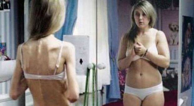Anoressia e bulimia, carcere e multe fino a 100mila euro a chi le promuove