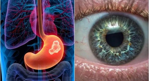 Tumore allo stomaco, scoperto un nuovo sintomo che permettere di riconoscerlo dall'occhio
