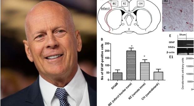 Demenza frontotemporale, nuova cura per Bruce Willis: ecco la molecola co-ultraPealut