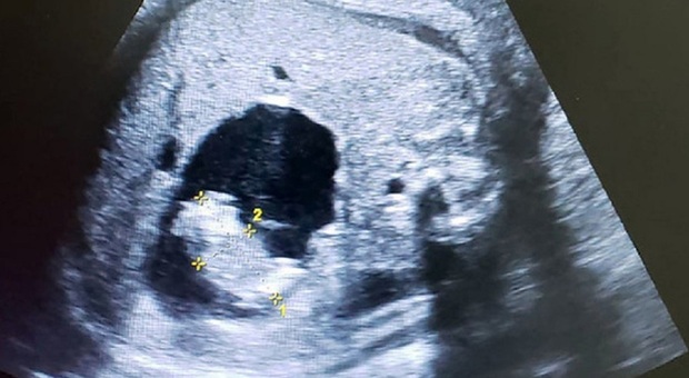 https://statics.cedscdn.it/photos/MED/94/52/8669452_20123939_fetus_in_fetu.jpg