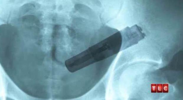 In ospedale per la stipsi, i medici trovano un vibratore ancora in funzione nel retto