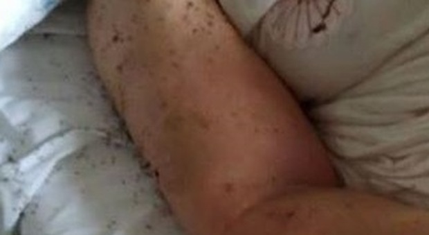Napoli, donna ricoverata tra le formiche: Lorenzin invia una task force