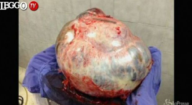 Choc in Messico, tumore da 60 chili rimosso dal corpo di una donna - Video