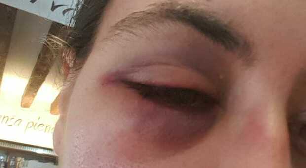 L'occhio pesto rimediato dalla barista a Marghera, aggredita e picchiata da un ubriaco