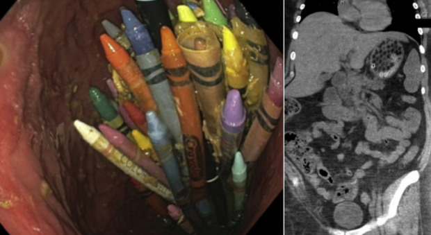 Pastelli e penne nello stomaco: la scoperta choc dei medici dopo che una donna si è presentata in una struttura psichiatrica
