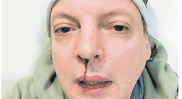 Dado, l'ex comico di Zelig aggredito dallo stalker 17enne della figlia: "Mi ha rotto il naso"