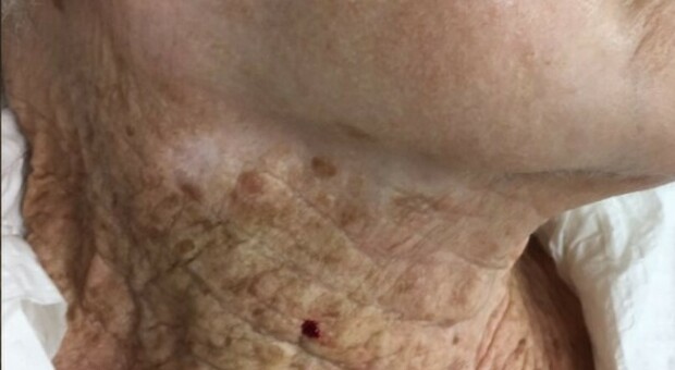 Mette la crema solare sul viso (ma non sul collo) per 4 decenni: ecco gli effetti sulla pelle di una donna di 92 anni