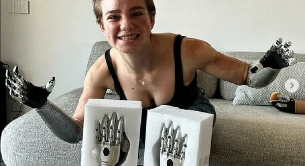 La campionessa di scherma e le nuove braccia bioniche: «Non vedo l'ora di provare le mani»