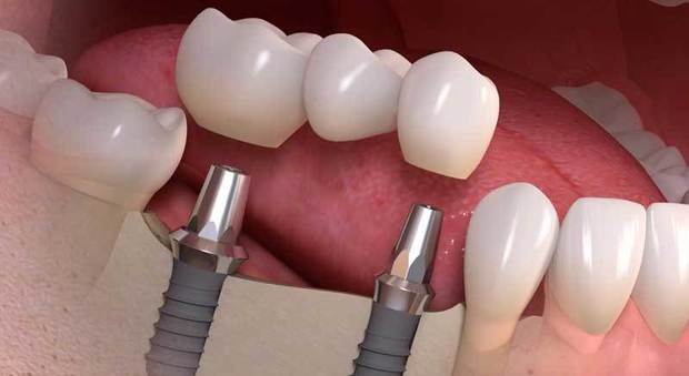 Etica Dentale presenta l'implantologia a carico immediato per denti fissi in poche ore