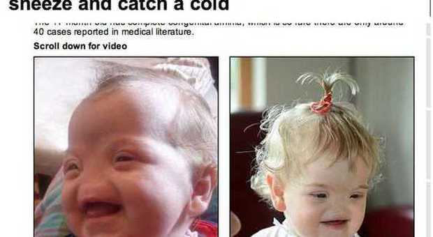 Tessa Evans, la bimba nata senza naso (DailyMail)