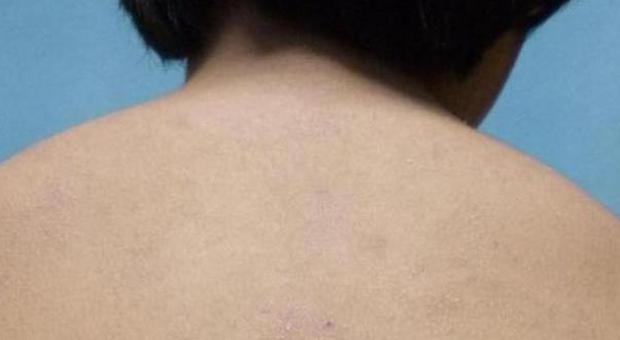 Bimbo di 11 anni allergico all'iPad, scatta l'allarme: ricoverato con uno sfogo enorme sulla pelle