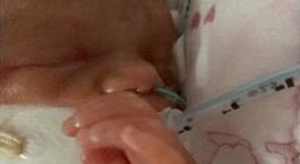 Lydia, la bimba nata dopo sole 24 settimane (Facebook)