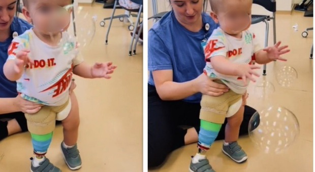 Bambino con gamba amputata a 9 mesi muove finalmente i primi passi grazie a un arto prostetico: il video è commovente