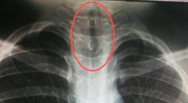 "Dottore, ho mal di gola e vertigini": ecco cosa ​c'era nella laringe del bimbo di 11 anni