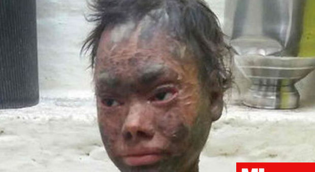Una rara malattia le fa perdere la pelle, 16enne cacciata da scuola: "Spaventa i compagni"