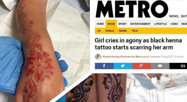 La bimba è allergica all'henné, il tatuaggio le provoca dolorose vesciche su tutto il braccio