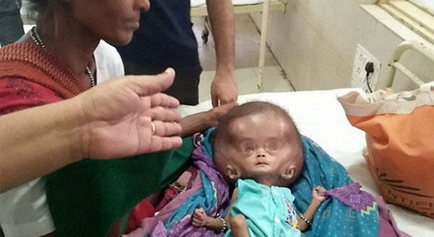 "La sua testa gigante non smette di crescere", bimba di 4 mesi rischia la vita