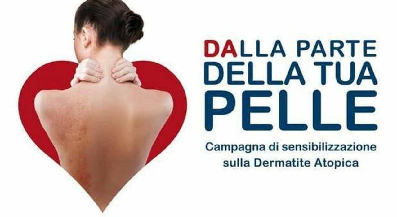 Napoli, open day sulla dermatite atopica al policlinico Vanvitelli con  consulti gratuiti