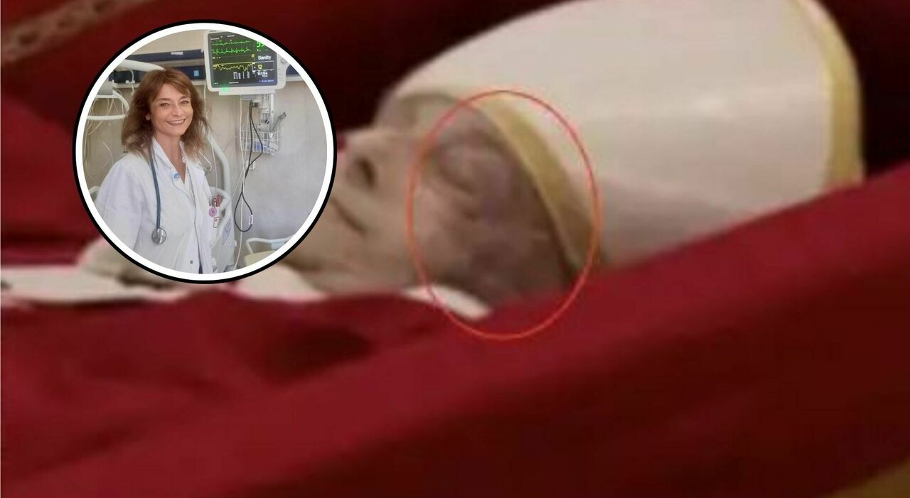 Papa Francesco, cosa c'è dietro la macchia sul volto. La neurologa: «Ecco cosa bisogna chiarire sull'ictus». S