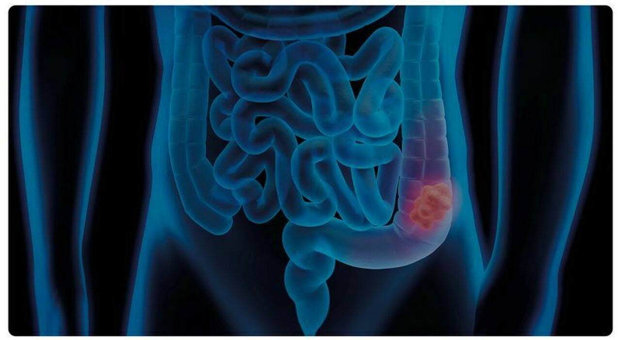 Les Jeunes Femmes et le Risque Accru de Cancer