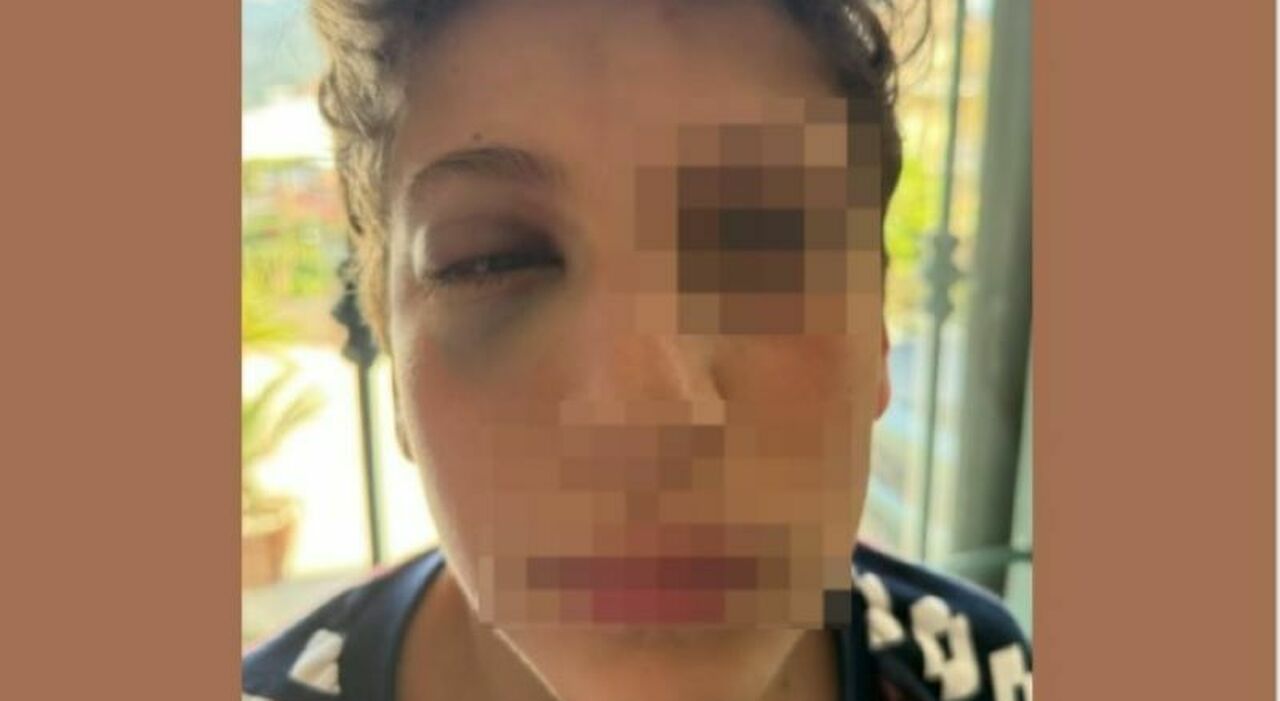 Ragazzo di 14anni aggredito da un coetaneo, il papà pubblica la foto con i lividi: «ll ragazzo che ha picchiato Ernesto è rimasto in pizzeria a festeggiare» Ragazzo di 14anni aggredito da un coetaneo, il papà pubblica la foto con i lividi: «ll ragazzo che ha picchiato Ernesto è rimasto in pizzeria a festeggiare»