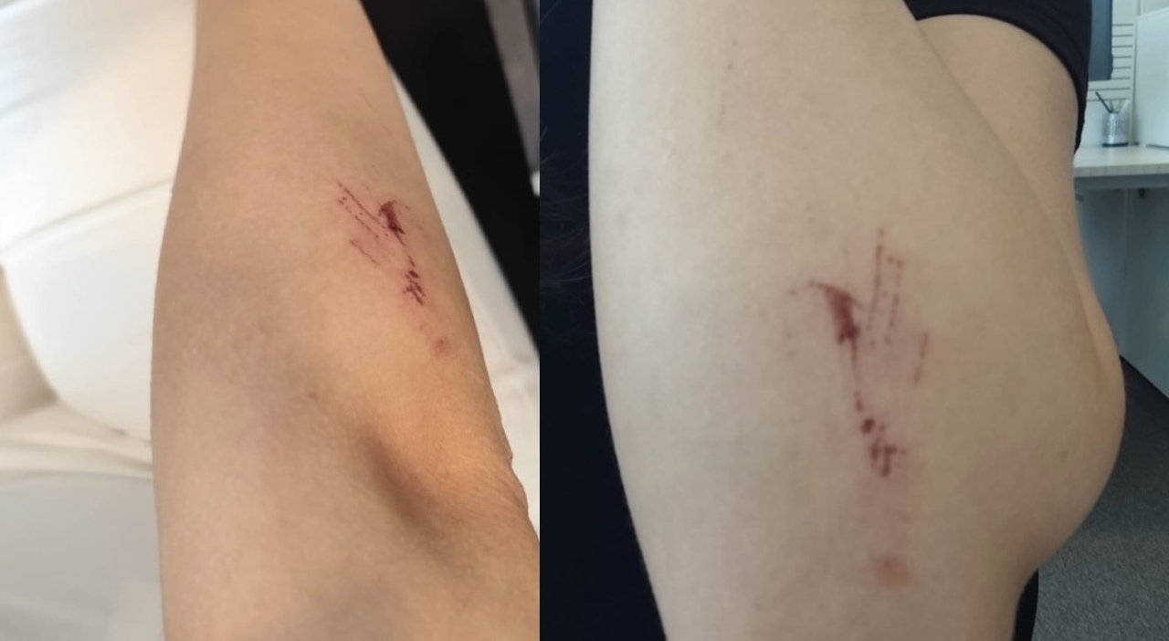 «Aggredita in pieno giorno da una straniera che mi ha riempita di botte e mi ha sputato: ho il terrore di uscire di casa» «Aggredita in pieno giorno da una straniera che mi ha riempita di botte e mi ha sputato: ho il terrore di uscire di casa»