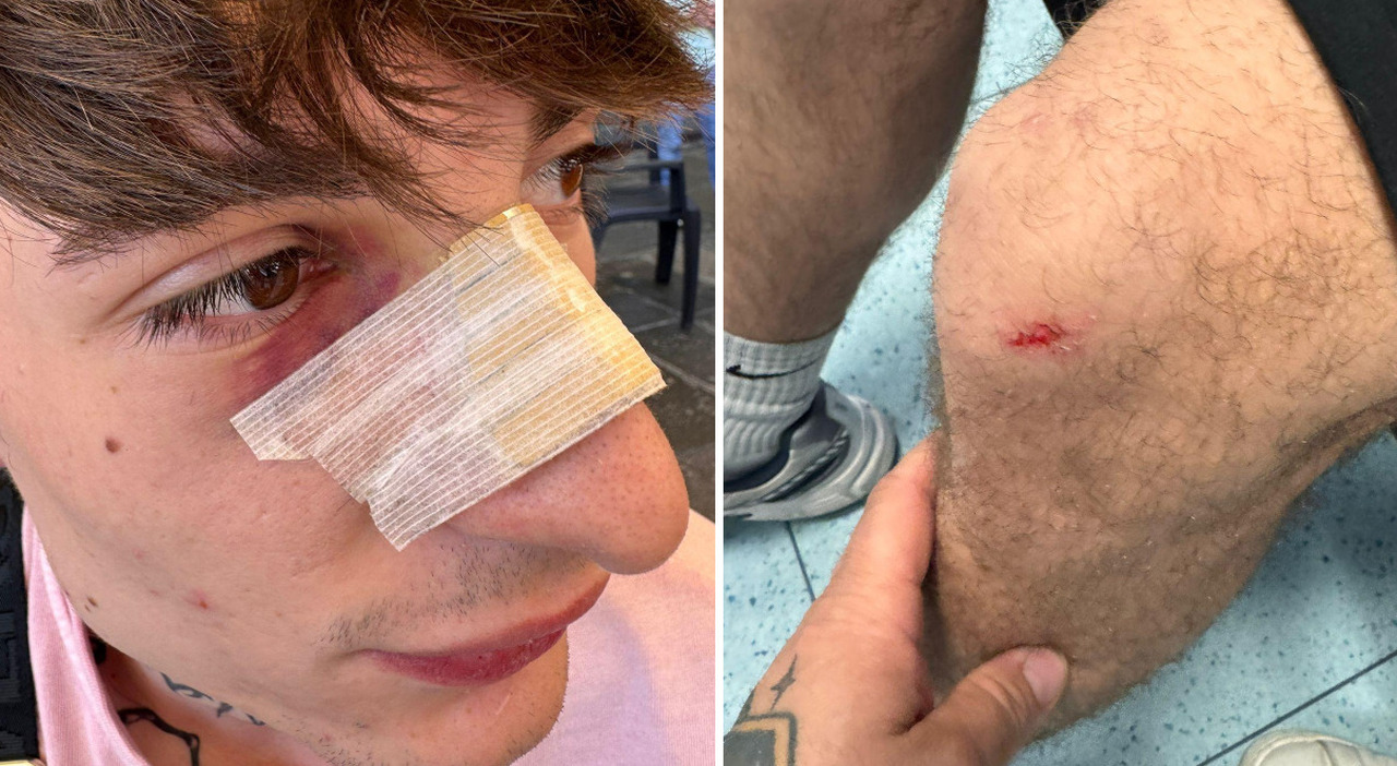nicolas sangiorgio picchiato a sangue per rapinarlo del suo zaino gucci tu non sai chi sono io il 19enne rimedia naso fratturato e lesioni