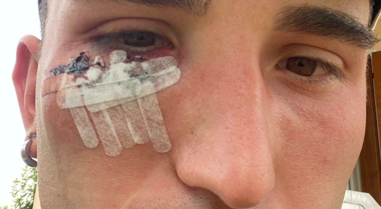 Carlo Zardo cerca di fermare la lite e viene colpito con un pugno in faccia da un marocchino: «Mi ha quasi preso l Carlo Zardo cerca di fermare la lite e viene colpito con un pugno in faccia da un marocchino: «Mi ha quasi preso l