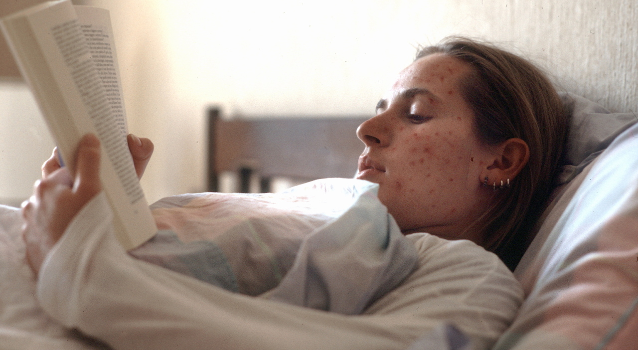Morbillo, allarme mondiale: torna negli USA e dilaga in Europa. In Italia casi raddoppiati in un mese Morbillo, allarme mondiale: torna negli USA e dilaga in Europa. In Italia casi raddoppiati in un mese