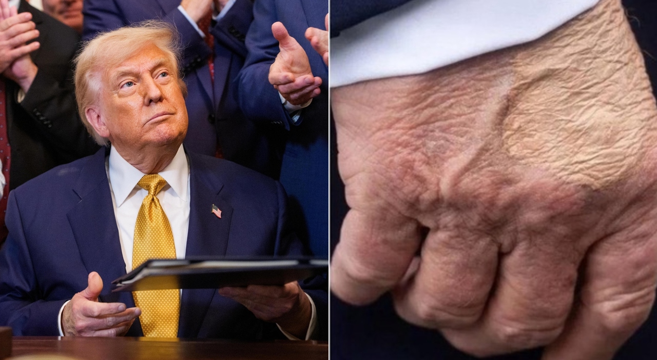 Donad Trump ha un'insufficienza venosa cronica. I lividi? Colpa delle  frequenti strette di mano»