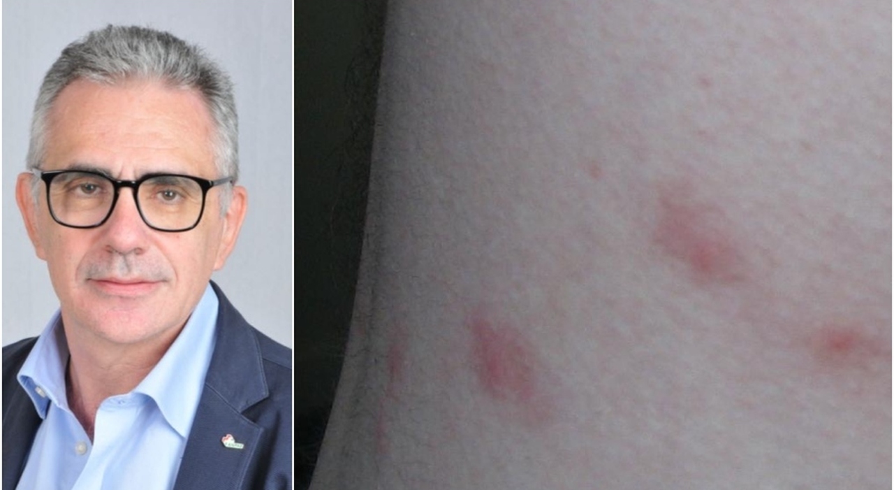 West Nile: come riconoscere la zanzara, cosa sapere sulla puntura e i 5 sintomi. Pregliasco: «Virus può durare settimane» West Nile: come riconoscere la zanzara, cosa sapere sulla puntura e i 5 sintomi. Pregliasco: «Virus può durare settimane»