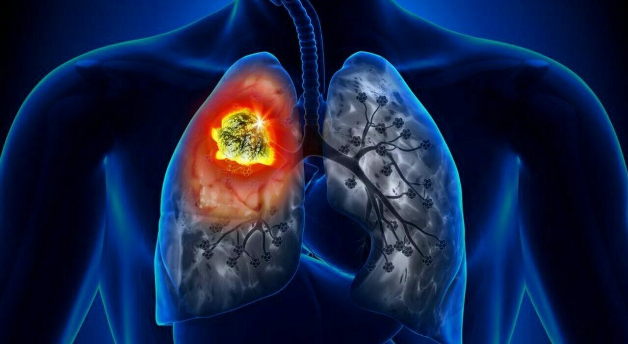 tumori 232 allarme i morti di cancro supereranno i 18 milioni nel 2050 75 lo studio su lancet dal fumo alla dieta come prevenirli