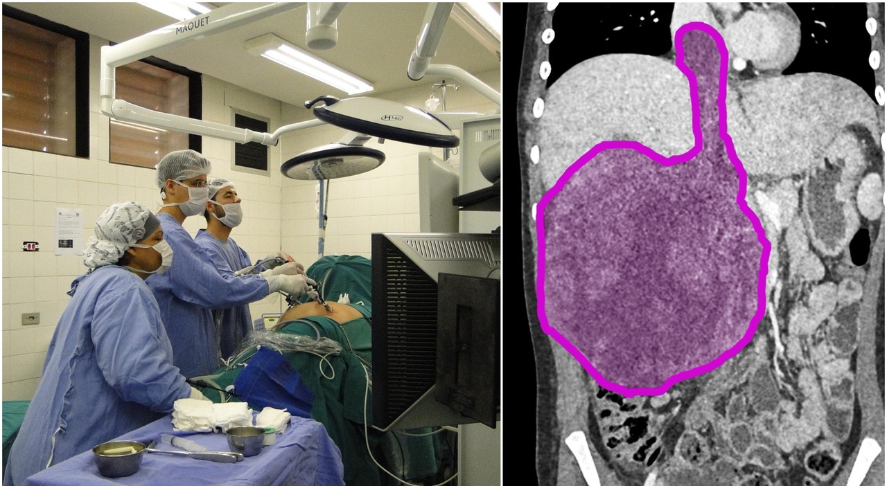 tumore ultrasuoni come cura la scoperta casuale che sta rivoluzionando la medicina cosa 232 l istotripsia e come funziona