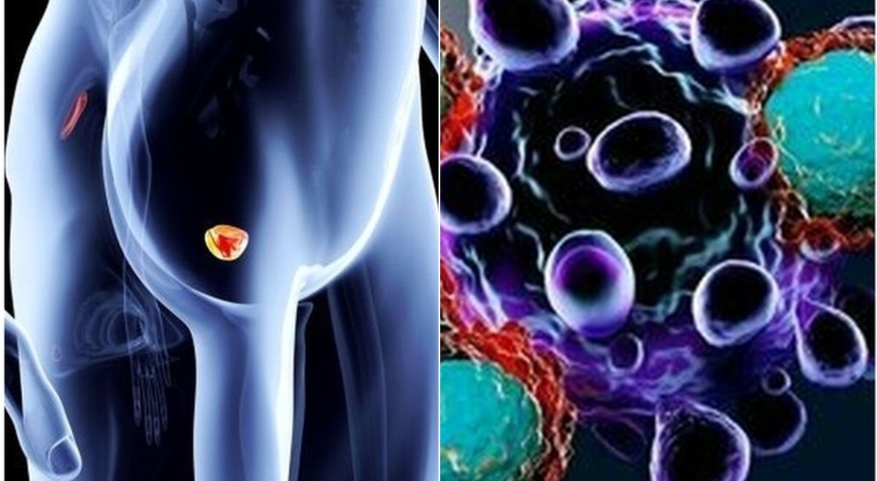 stavo bene non avevo nessun sintomo e non mi sono controllato ora ho un tumore alla prostata non fate i miei stessi errori