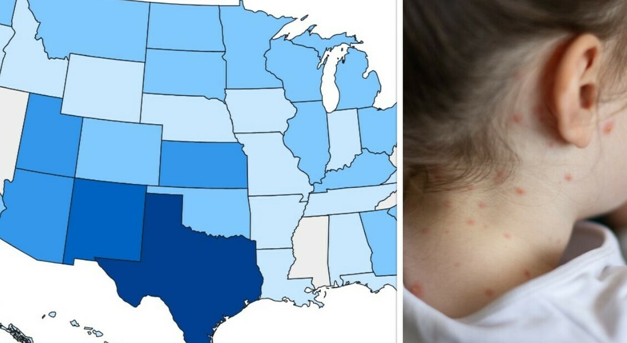 https://statics.cedscdn.it/photos/MED_HIGH/2025/10/13/9124229_13103142_morbillo_usa_measles_focolaio_quarantena_bassetti_oggi_13_10_2025.jpg